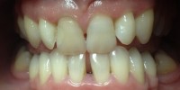 Izbjeljivanje zuba-prije 3
